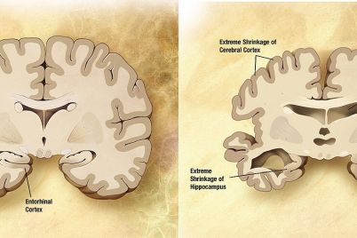 1280px-Alzheimers_disease_brain_comparison.jpg