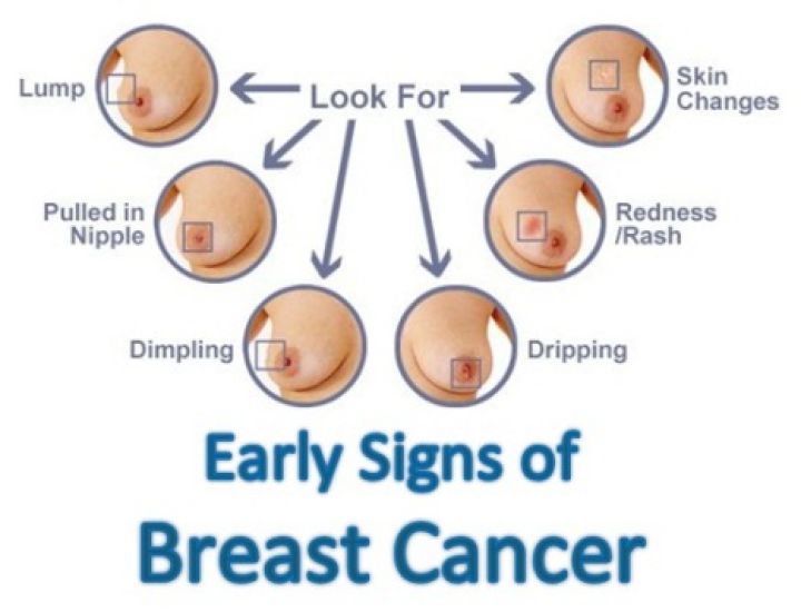 Breast-Cancer-Symptoms.jpg
