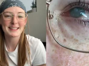 မျက်ကပ်မှန်တပ်ပြီး ရေချိုးမိလိုက်လို့ မျက်စိကွယ်သွားခဲ့ရတဲ့ အသက် ၂၀ အရွယ်မိန်းကလေး