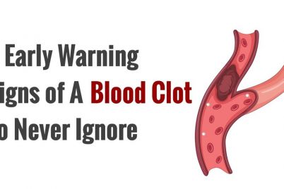 blood-clot-warning-signs.jpg