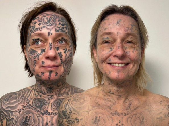 ချစ်သူဟောင်းရဲ့ အတင်းအကြပ်ခိုင်းစေမှုကြောင့် ရေးထိုးခဲ့ရတဲ့ တက်တူး ၂၅၀ ကို ဖယ်ရှားဖို့ ကြိုးစားနေသူ